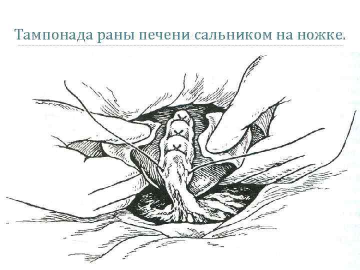 Тампонада раны печени сальником на ножке. 