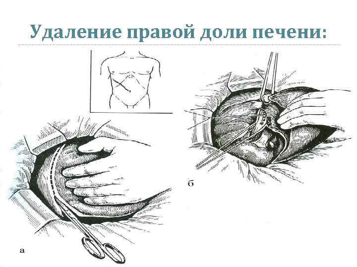 Удаление правой доли печени: 
