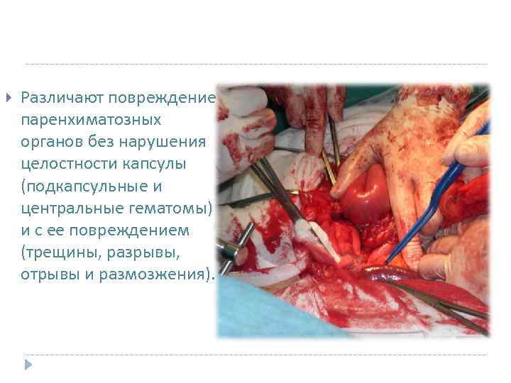  Различают повреждение паренхиматозных органов без нарушения целостности капсулы (подкапсульные и центральные гематомы) и