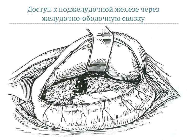 Поперечный разрез через сальниковую сумку схема - 84 фото