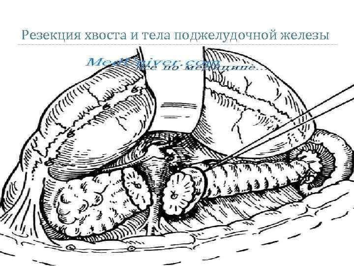 Резекция поджелудочной железы схема