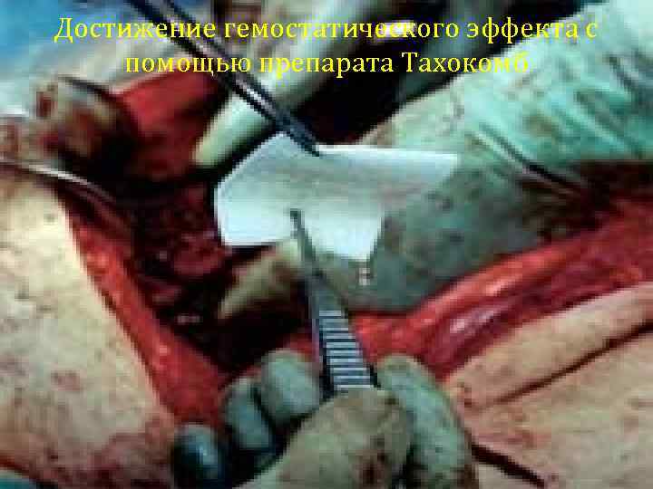 Достижение гемостатического эффекта с помощью препарата Тахокомб 