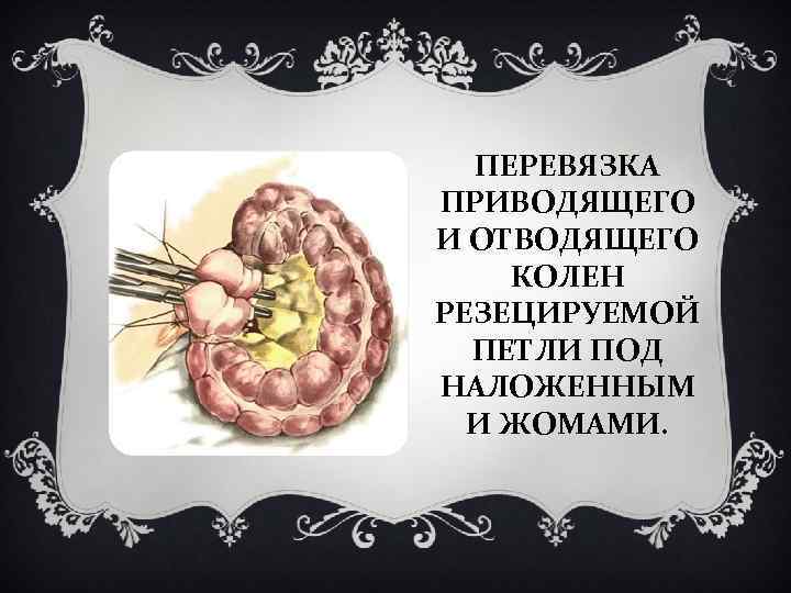 ПЕРЕВЯЗКА ПРИВОДЯЩЕГО И ОТВОДЯЩЕГО КОЛЕН РЕЗЕЦИРУЕМОЙ ПЕТЛИ ПОД НАЛОЖЕННЫМ И ЖОМАМИ. 