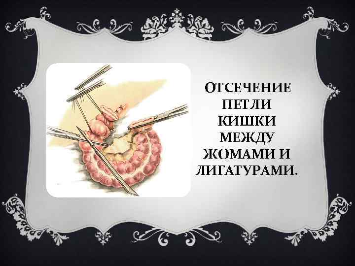 ОТСЕЧЕНИЕ ПЕТЛИ КИШКИ МЕЖДУ ЖОМАМИ И ЛИГАТУРАМИ. 