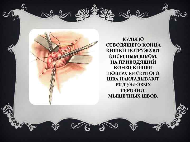 КУЛЬТЮ ОТВОДЯЩЕГО КОНЦА КИШКИ ПОГРУЖАЮТ КИСЕТНЫМ ШВОМ. НА ПРИВОДЯЩИЙ КОНЕЦ КИШКИ ПОВЕРХ КИСЕТНОГО ШВА