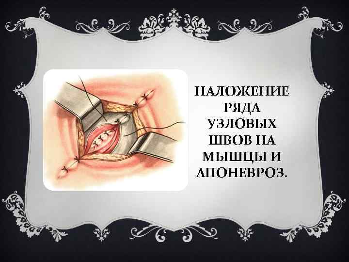 НАЛОЖЕНИЕ РЯДА УЗЛОВЫХ ШВОВ НА МЫШЦЫ И АПОНЕВРОЗ. 