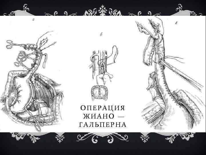 ОПЕРАЦИЯ ЖИАНО — ГАЛЬПЕРНА 