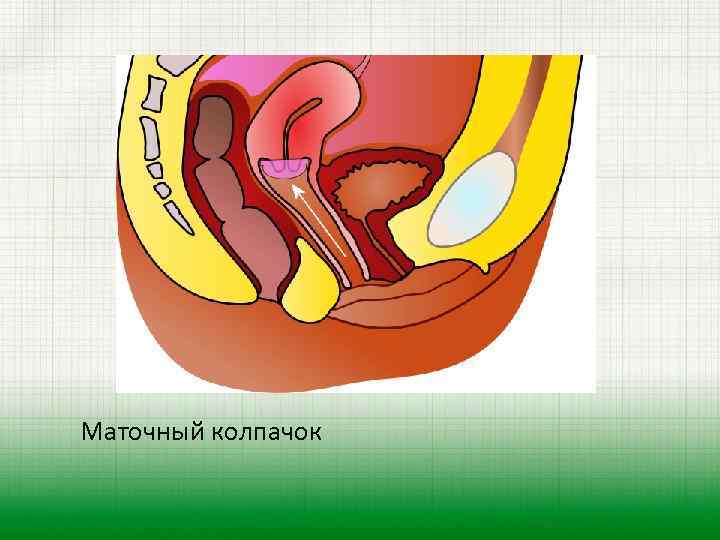 Маточный колпачок 