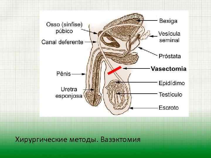 Хирургические методы. Вазэктомия 