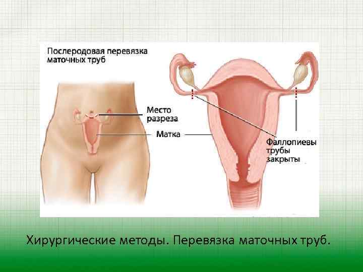 Хирургические методы. Перевязка маточных труб. 