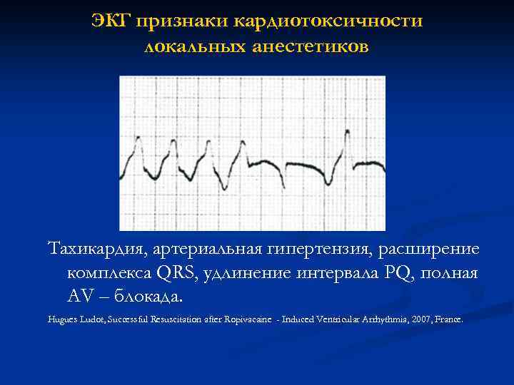 ЭКГ признаки кардиотоксичности локальных анестетиков Тахикардия, артериальная гипертензия, расширение комплекса QRS, удлинение интервала PQ,