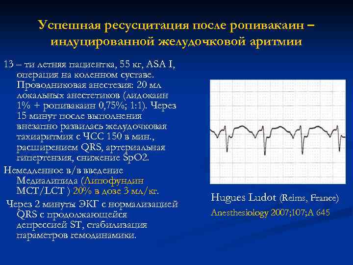 Успешная ресусцитация после ропивакаин – индуцированной желудочковой аритмии 13 – ти летняя пациентка, 55