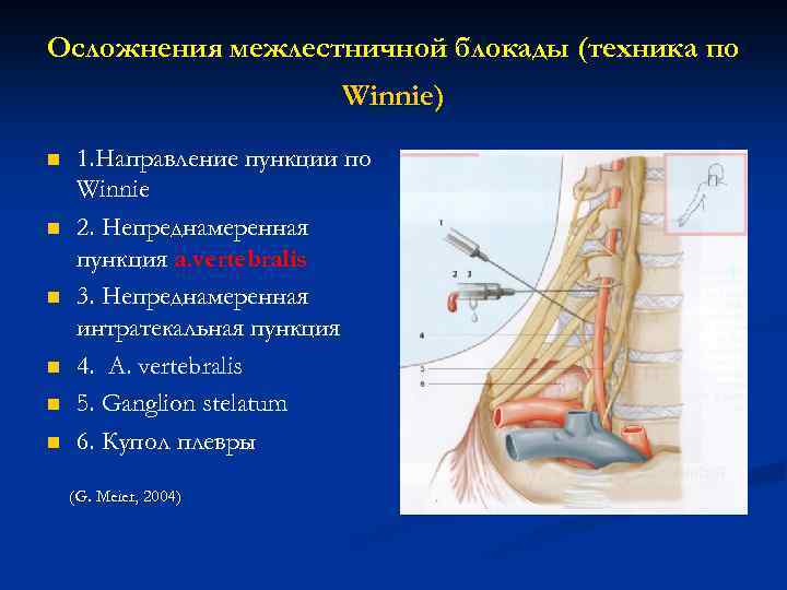 Осложнения межлестничной блокады (техника по Winnie) n n n 1. Направление пункции по Winnie