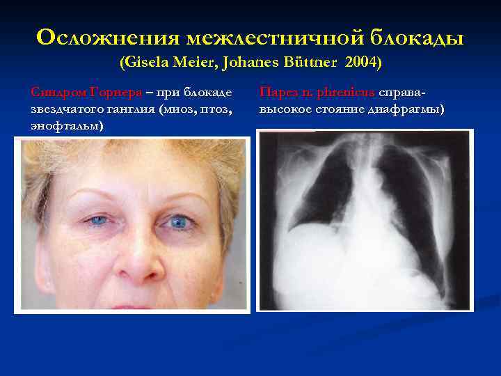 Осложнения межлестничной блокады (Gisela Meier, Johanes Büttner 2004) Синдром Горнера – при блокаде звездчатого