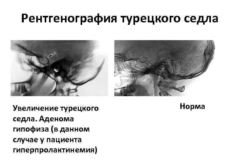 Рентгенография турецкого седла Увеличение турецкого седла. Аденома гипофиза (в данном случае у пациента гиперпролактинемия)