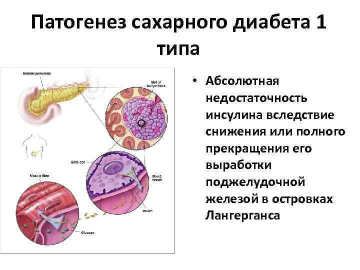 Диабет патогенез. СД 1 типа этиология и патогенез. Механизм развития диабета 1 типа. Этиопатогенез СД 1 типа. Механизм развития сахарного диабета 1 типа.