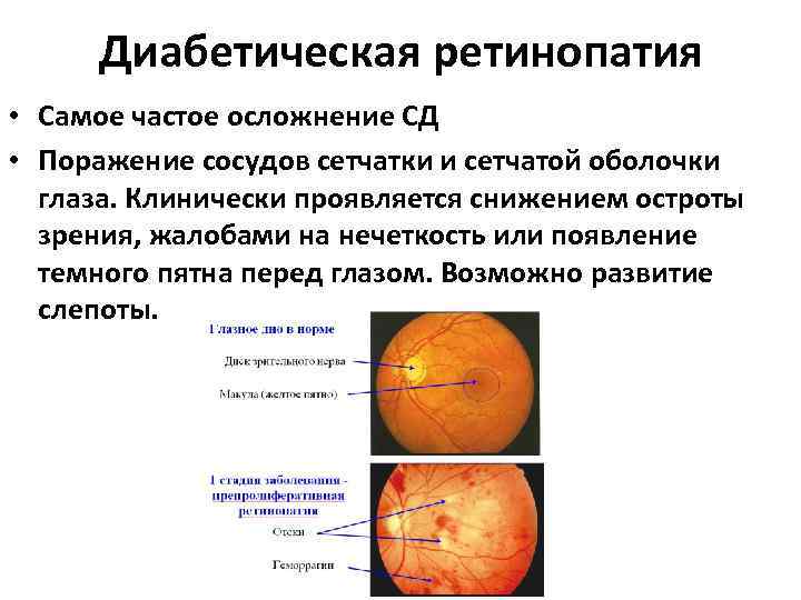 Диабетическая ретинопатия • Самое частое осложнение СД • Поражение сосудов сетчатки и сетчатой оболочки
