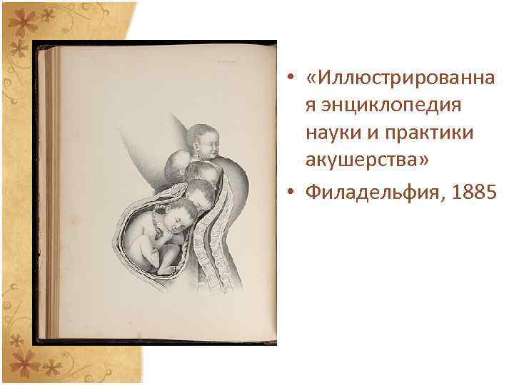  • «Иллюстрированна я энциклопедия науки и практики акушерства» • Филадельфия, 1885 