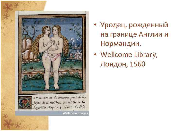  • Уродец, рожденный на границе Англии и Нормандии. • Wellcome Library, Лондон, 1560