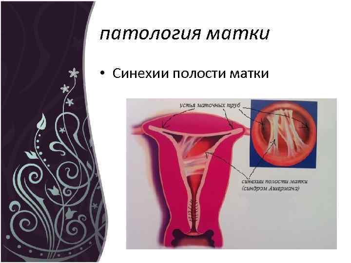 патология матки • Синехии полости матки 