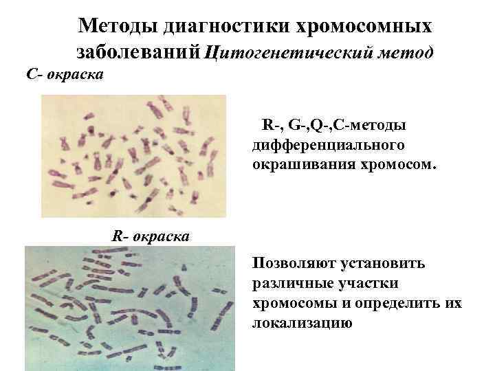 Методы диагностики хромосомных заболеваний Цитогенетический метод С- окраска R-, G-, Q-, C-методы дифференциального окрашивания