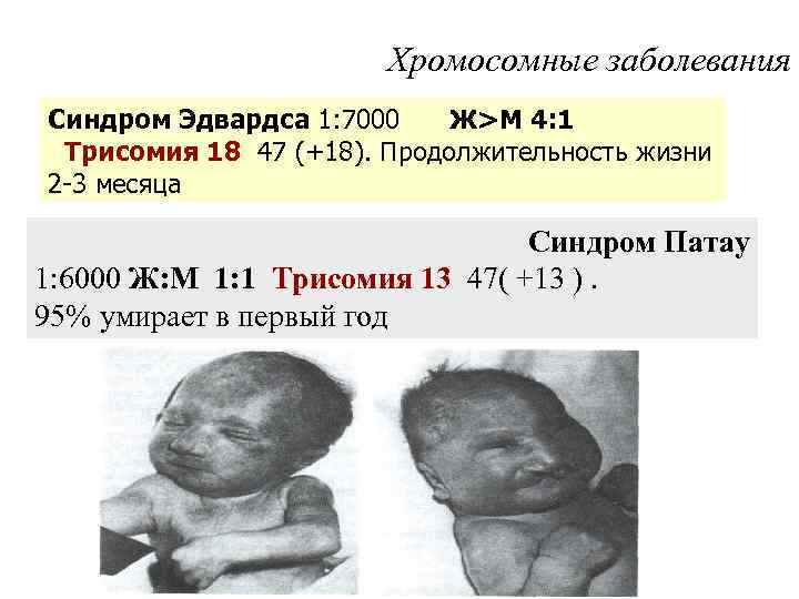 Хромосомные заболевания Синдром Эдвардса 1: 7000 Ж>М 4: 1 Трисомия 18 47 (+18). Продолжительность