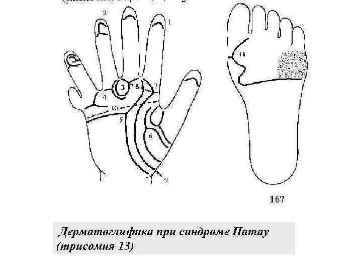 Дерматоглифика при синдроме Патау (трисомия 13) 