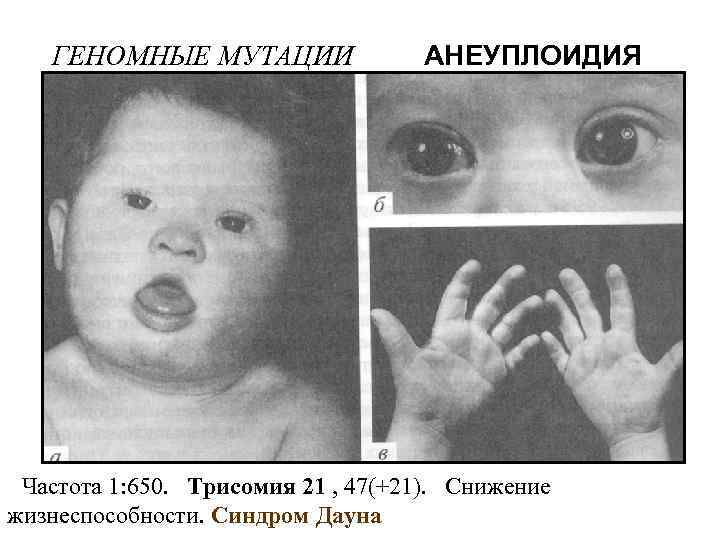 ГЕНОМНЫЕ МУТАЦИИ АНЕУПЛОИДИЯ Частота 1: 650. Трисомия 21 , 47(+21). Снижение жизнеспособности. Синдром Дауна