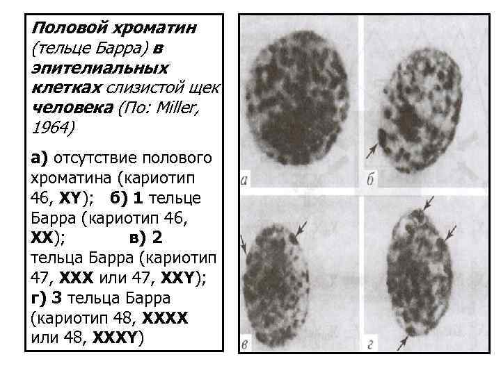 Половой хроматин (тельце Барра) в эпителиальных клетках слизистой щек человека (По: Мiller, 1964) а)