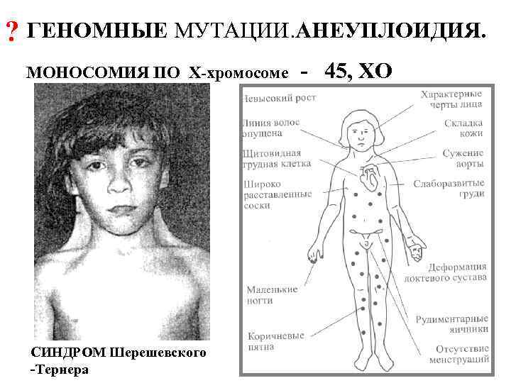 ? ГЕНОМНЫЕ МУТАЦИИ. АНЕУПЛОИДИЯ. МОНОСОМИЯ ПО Х-хромосоме СИНДРОМ Шерешевского -Тернера - 45, ХО 