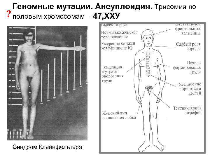 Геномные мутации. Анеуплоидия. Трисомия по ? половым хромосомам - 47, ХХУ Синдром Клайнфельтера 