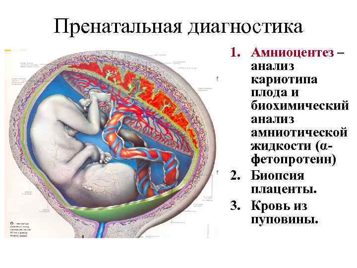 Пренатальная диагностика 1. Амниоцентез – анализ кариотипа плода и биохимический анализ амниотической жидкости (αфетопротеин)