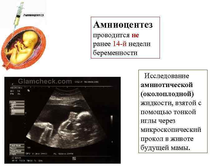 Амниоцентез проводится не ранее 14 -й недели беременности Исследование амниотической (околоплодной) жидкости, взятой с