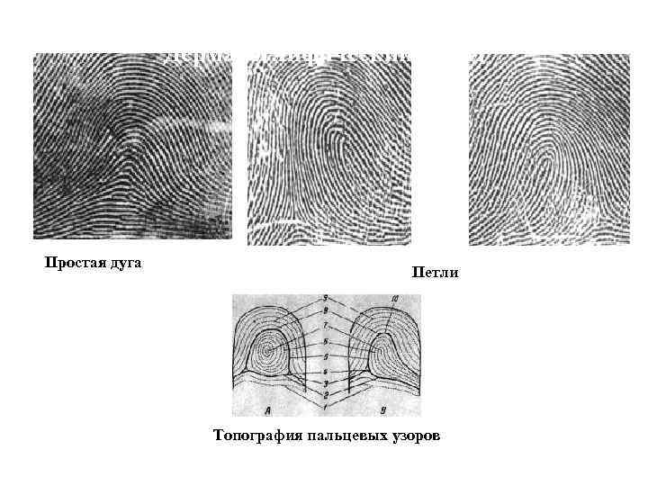 Дерматоглифический метод Простая дуга Петли Топография пальцевых узоров 