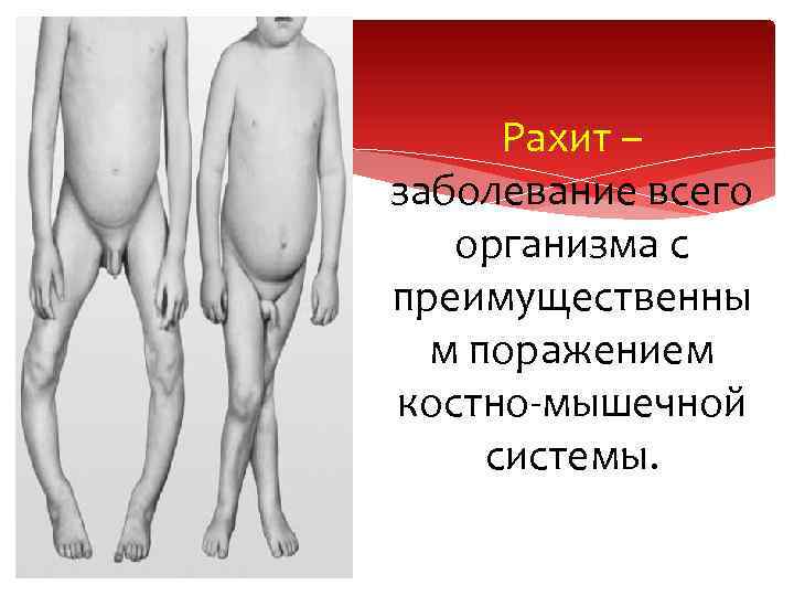 Рахит – заболевание всего организма с преимущественны м поражением костно-мышечной системы. 