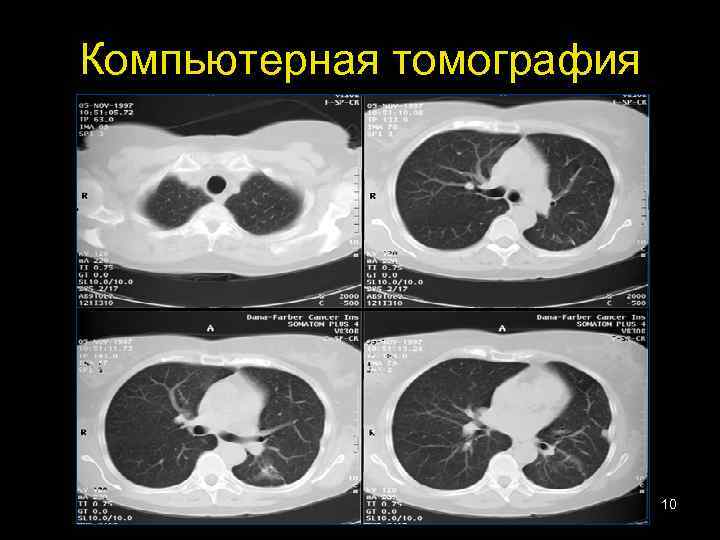 Компьютерная томография 10 