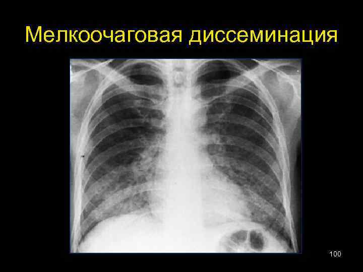 Мелкоочаговая диссеминация 100 