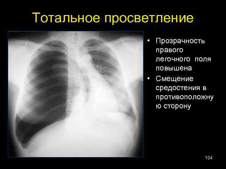 Тотальное просветление • Прозрачность правого легочного поля повышена • Смещение средостения в противоположну ю