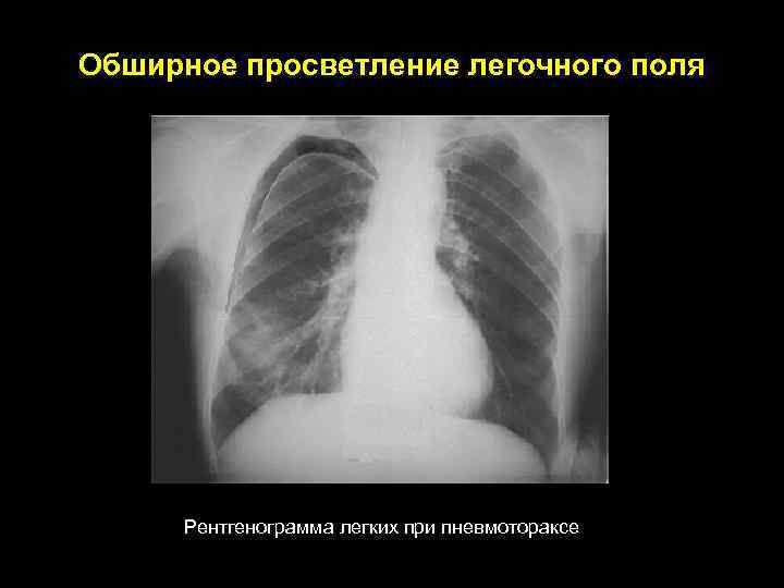 Просветление в легких. Обширное просветление легочного поля. Диффузное просветление легочной ткани. Пневмоторакс просветление. Просветление легочного поля рентген.