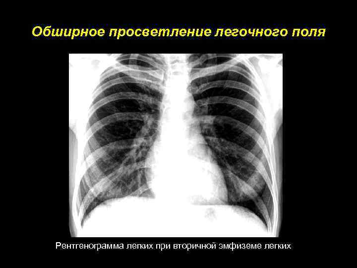 Поле легкого. Эмфизема лёгких рентгенограмма просветление. Синдром обширного просветления. Обширное просветление легочного поля. Обширное просветление легких.