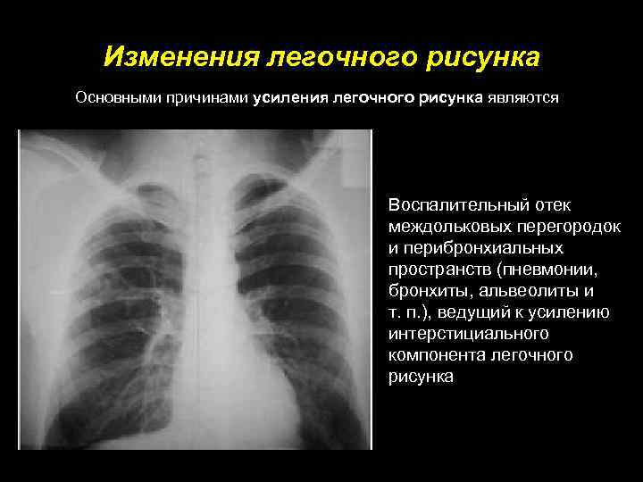 Легочный рисунок усилен за счет перибронхиального компонента