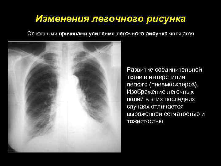 Деформирован легочный. Изменение легочного рисунка. Легочный рисунок усилен. Усиление легочного рисунка.