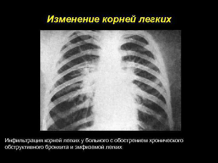 Изменение корней легких Инфильтрация корней легких у больного с обострением хронического обструктивного бронхита и