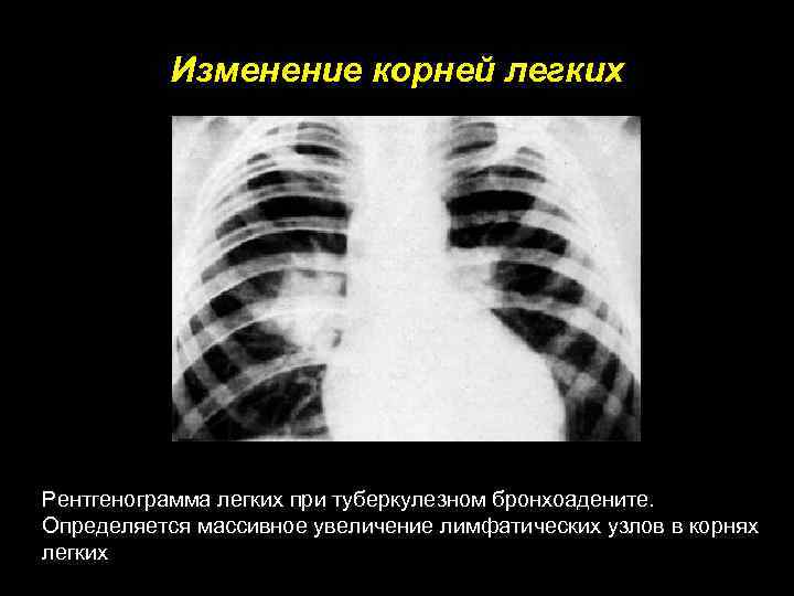 Изменение корней легких Рентгенограмма легких при туберкулезном бронхоадените. Определяется массивное увеличение лимфатических узлов в
