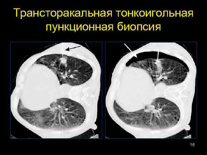 Трансторакальная тонкоигольная пункционная биопсия 16 