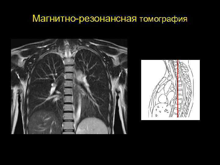 Мрт грудной клетки