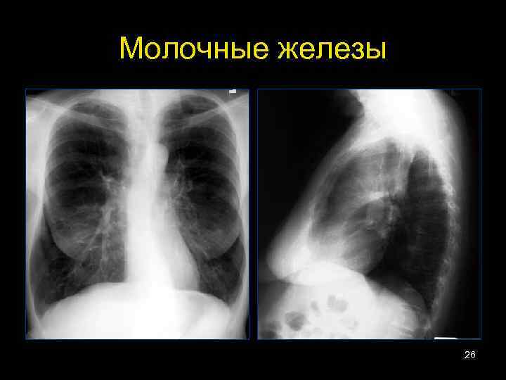 Молочные железы 26 