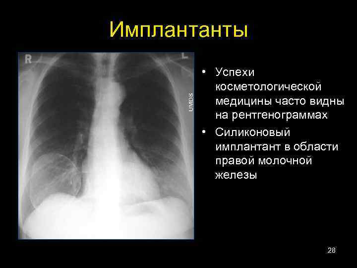 Имплантанты • Успехи косметологической медицины часто видны на рентгенограммах • Силиконовый имплантант в области