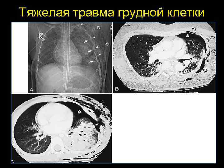 Тупая травма грудной клетки карта вызова