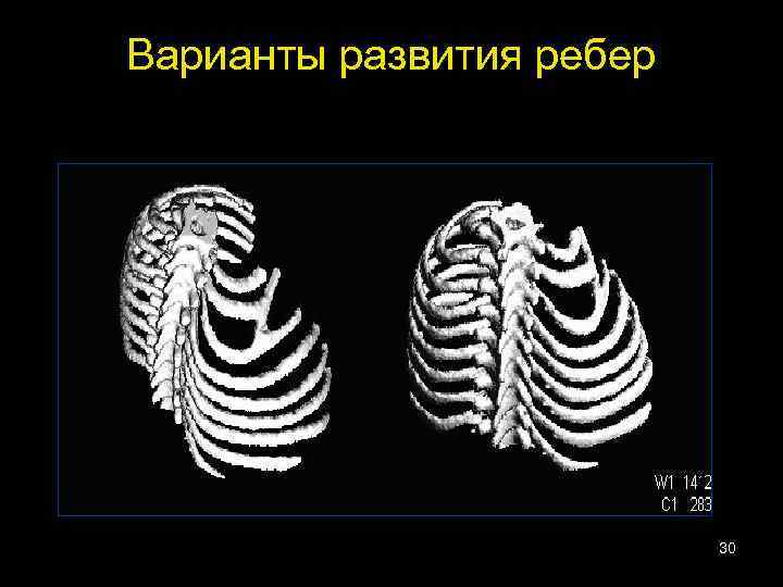 Варианты развития ребер 30 